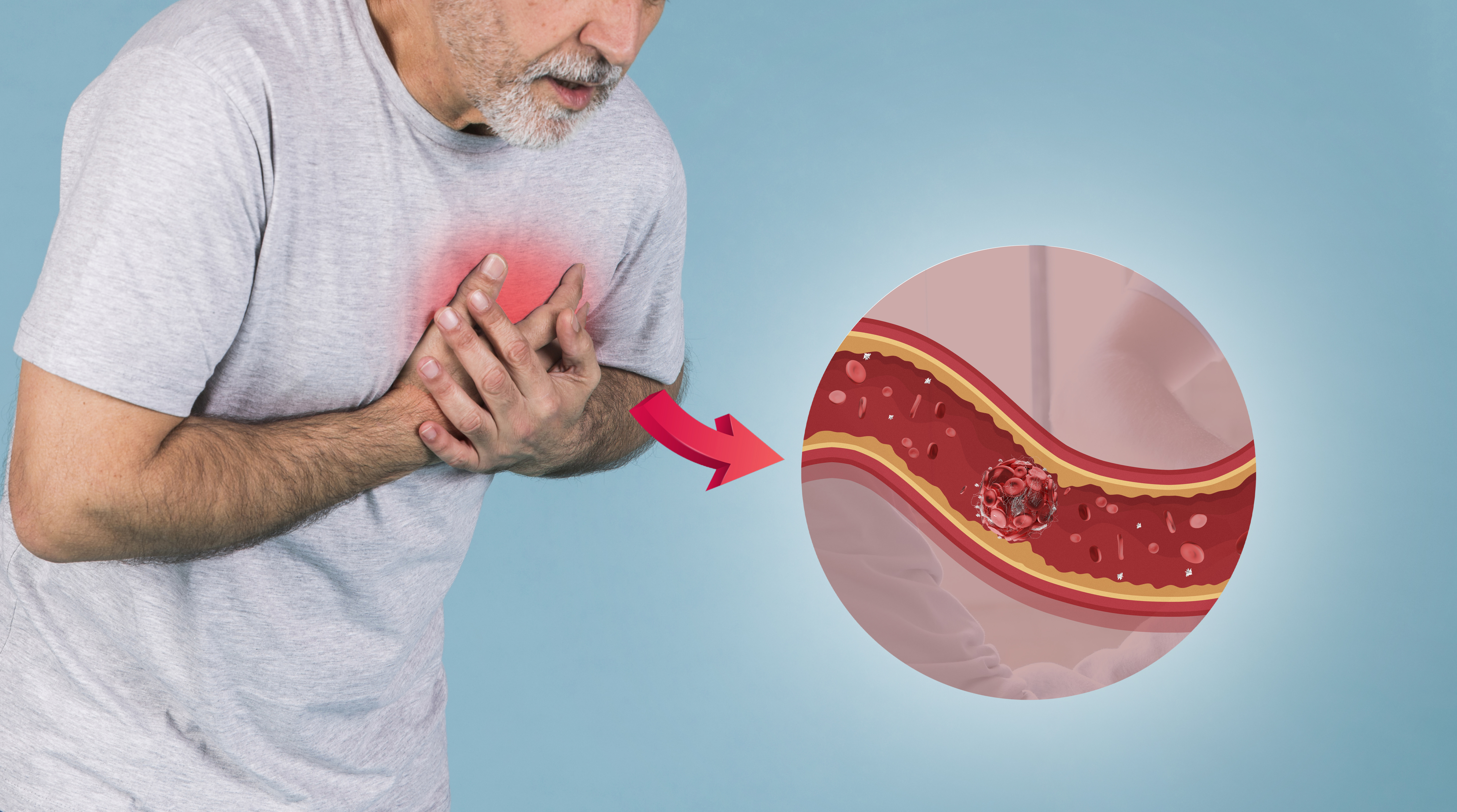 Recurrent Stent Thrombosis: Rethinking P2Y12 Selection