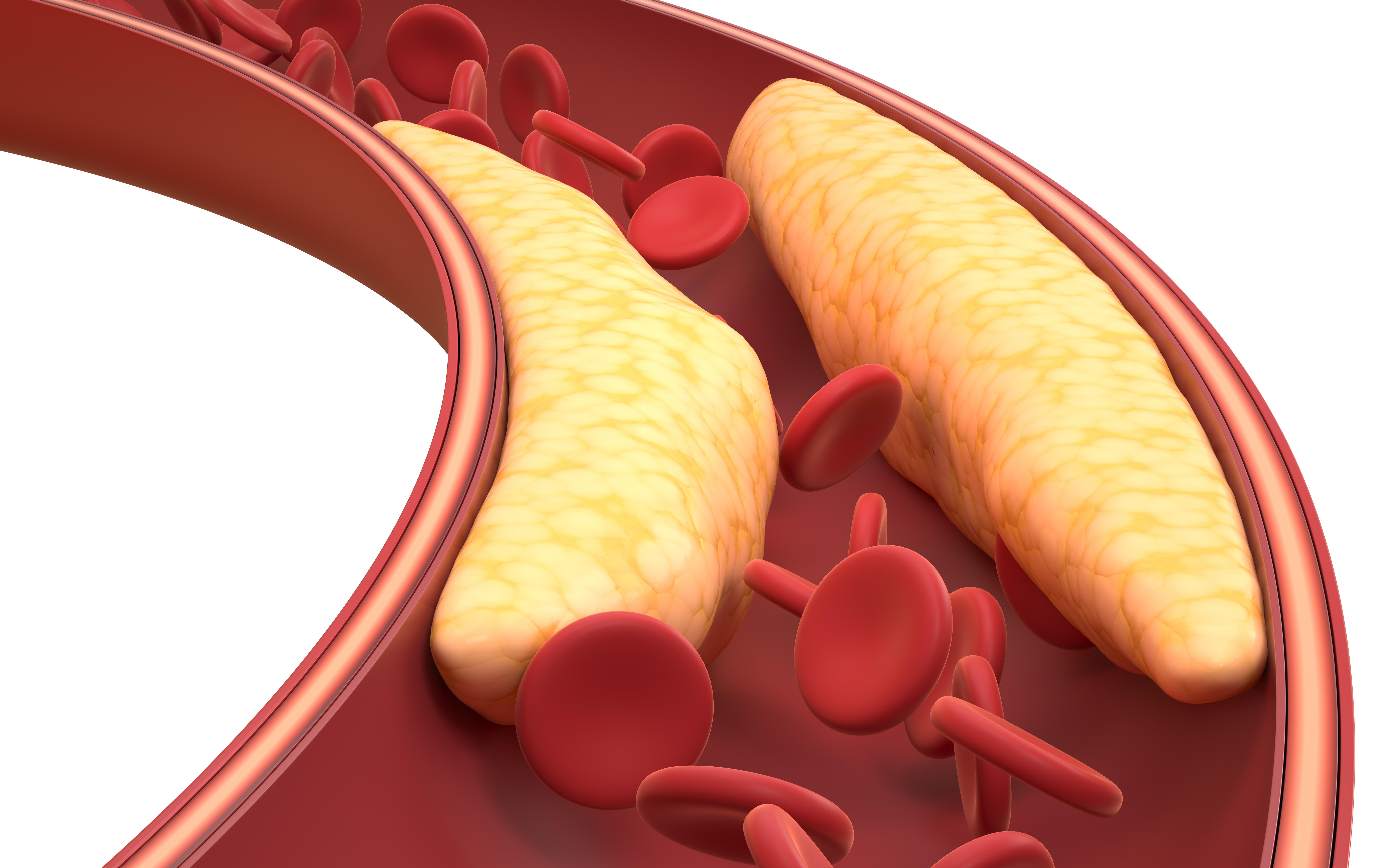 Clinical Decision-Making in Lipid-Lowering Therapy After ACS